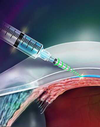 How To Sharpen A Hypodermic Needle - Face Med Store