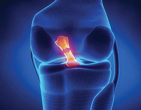 Anterior Cruciate Ligament (ACL) Tears (for Teens)